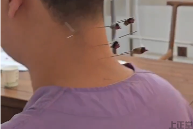 健康導(dǎo)讀!咳嗽哮喘針灸有什么作用